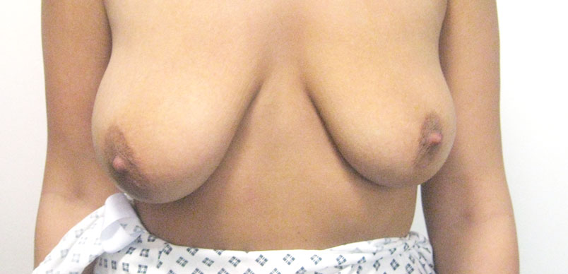 Before breast Implants to correct Breast Asymmetry Gallery